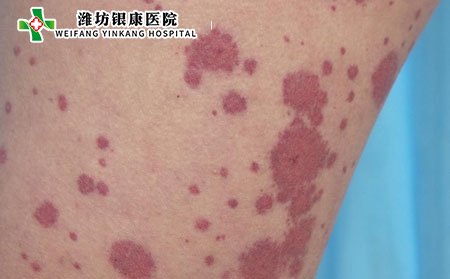 什么是過敏性紫癜癥狀有哪些?嚴重嗎?